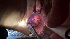 Electrosounding inner uterus Free Porn Videos
